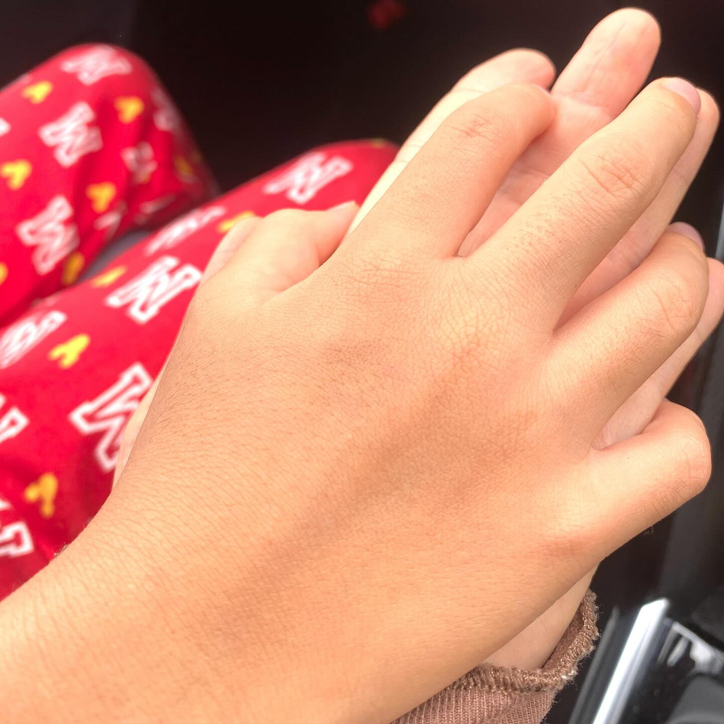 コンロの火に当たって右手を火傷してしまった息子💦
